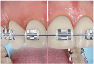 Perfect Smile ortho Flossing steps